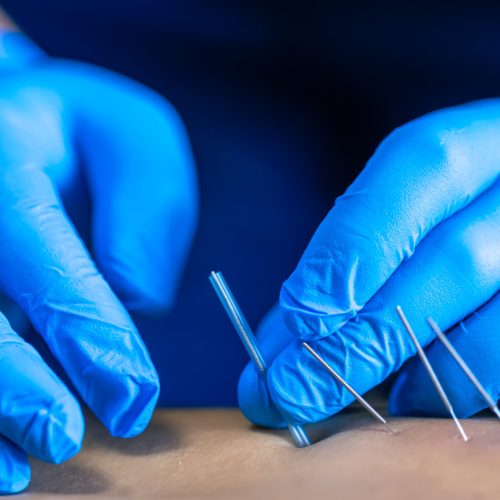 Close up of a needle and hands of physiotherapist doing a dry needling in a physiotherapy center.